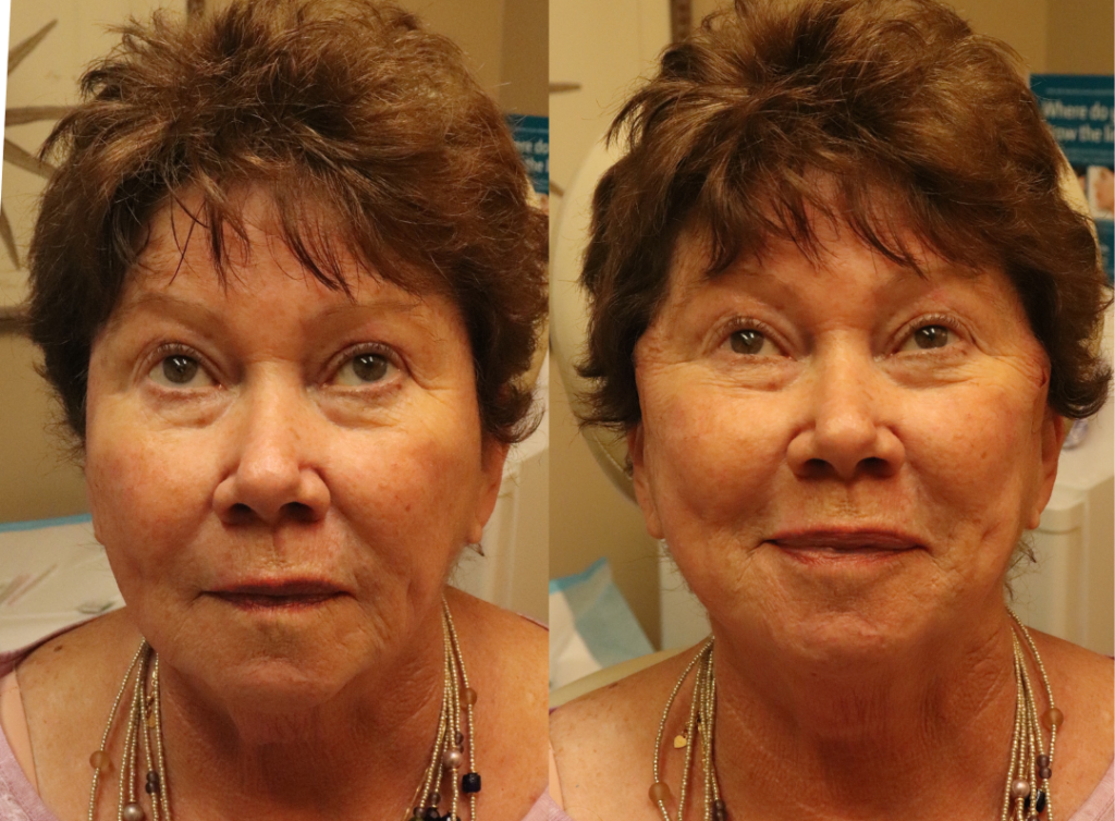 PDO-Mint Monothreads Before and After Photo by The Skin Care Center in Pensacola, FL