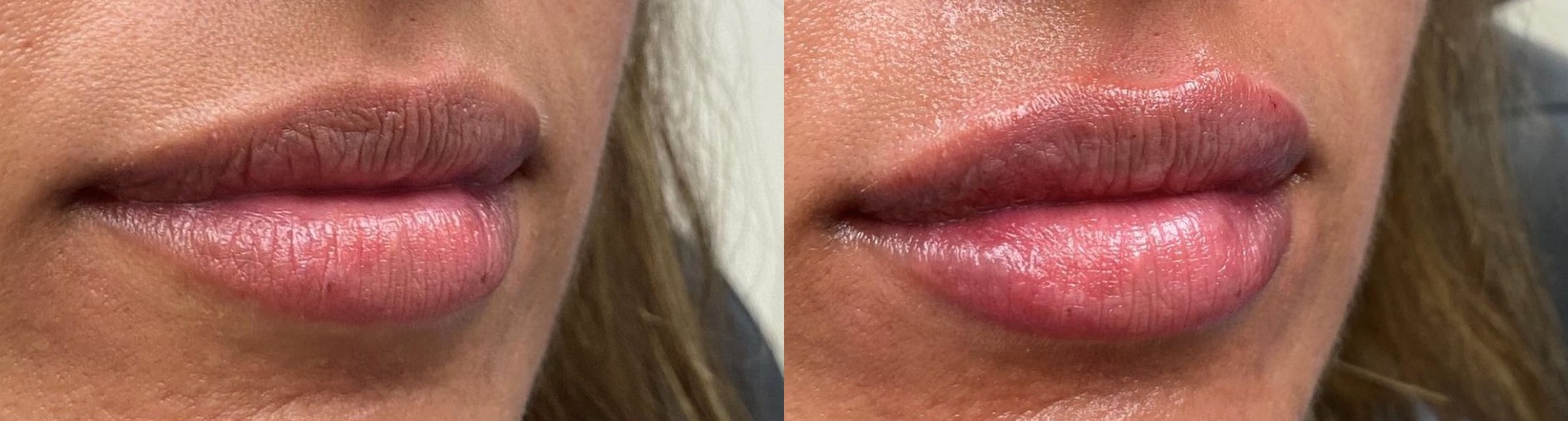 Dermal Filler Lips Before and After Photo by The Skin Care Center in Pensacola, FL
