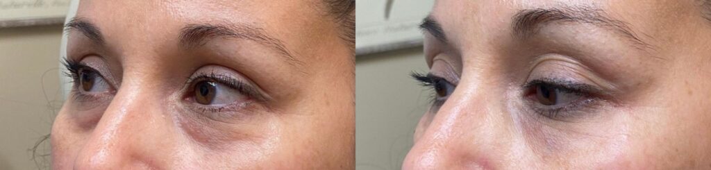 Dermal Filler Tear Trough Before and After Photo by The Skin Care Center in Pensacola, FL