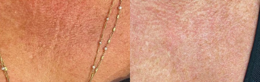 PDO-Mint Monothreads Before and After Photo by The Skin Care Center in Pensacola, FL