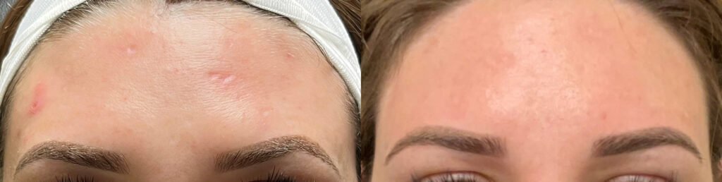 CoolPeel Laser Scar Treatment Before and After Photo by The Skin Care Center in Pensacola, FL