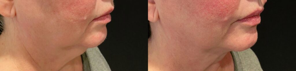 CoolSculpting and Kybella Before and After Photo by The Skin Care Center in Pensacola, FL