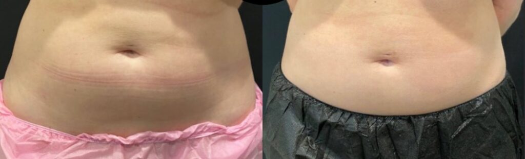 CoolSculpting of the abdomen Before and After Photo by The Skin Care Center in Pensacola, FL