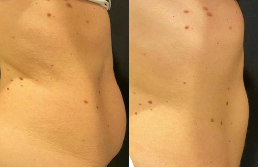 CoolSculpting of the abdomen Before and After Photo by The Skin Care Center in Pensacola, FL