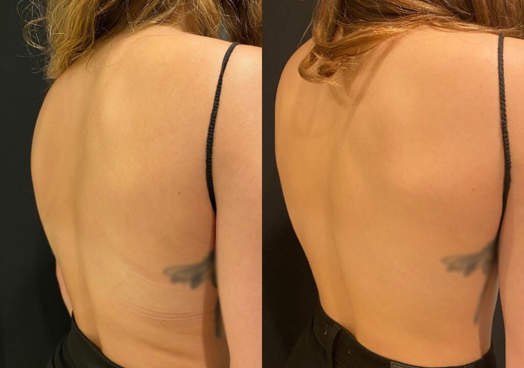 CoolSculpting of the bra fat area Before and After Photo by The Skin Care Center in Pensacola, FL