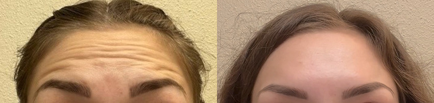 Botox Before and After Photo by The Skin Care Center in Pensacola, FL