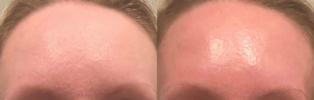Aquagold Before and After Photo by The Skin Care Center in Pensacola, FL
