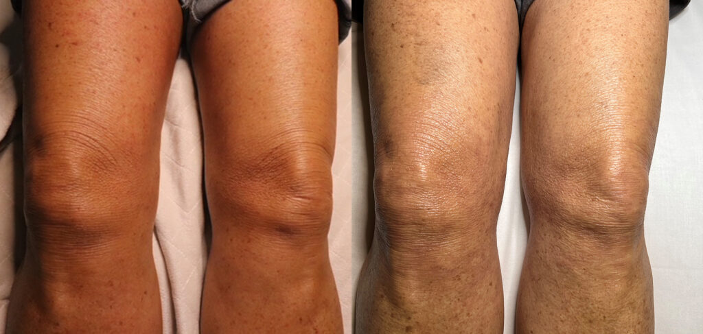 Microneedling of the knees Before and After Photo by The Skin Care Center in Pensacola, FL