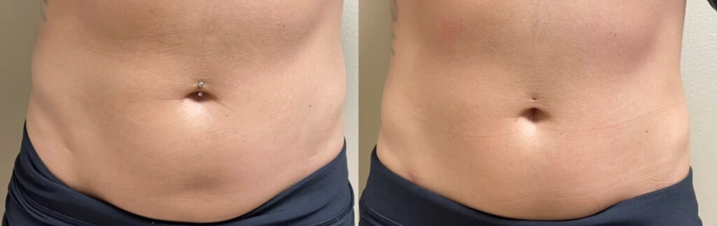CoolTone of the abdomen Before and After Photo by The Skin Care Center in Pensacola, FL