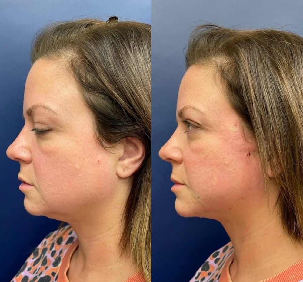 PDO Thread Lift Before and After Photo by The Skin Care Center in Pensacola, FL