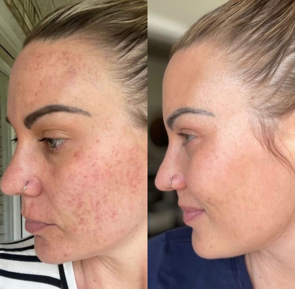IPL laser treatment for hyperpigmentation Before and After Photo by The Skin Care Center in Pensacola, FL