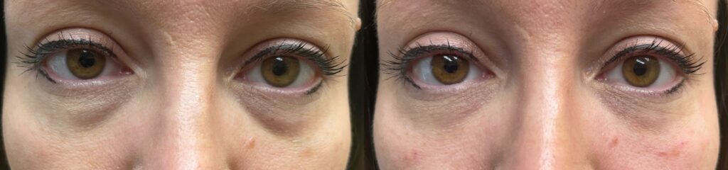 Dermal Filler Tear Trough Before and After Photo by The Skin Care Center in Pensacola, FL