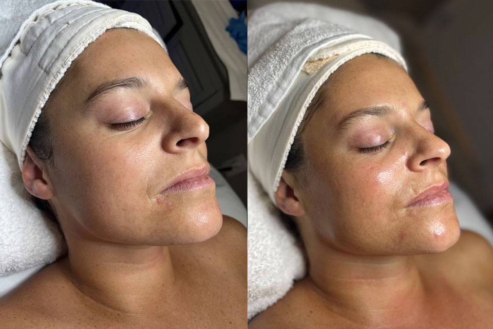 Hydrafacial - Before and After