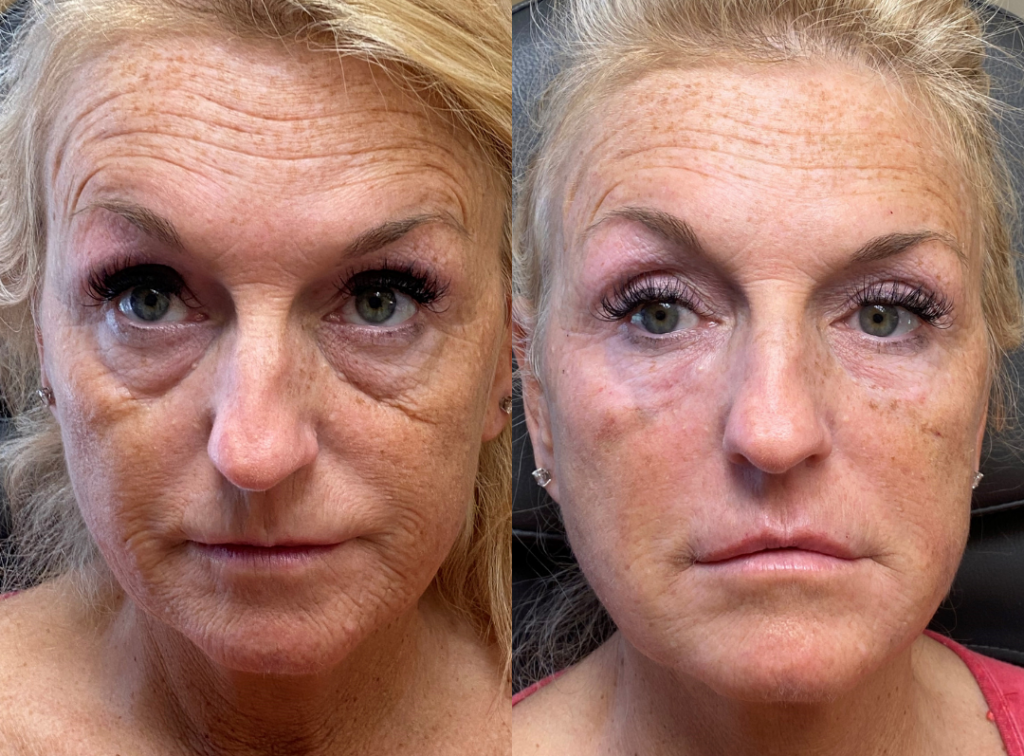 Dermal Fillers Before and After Photo by The Skin Care Center in Pensacola, FL