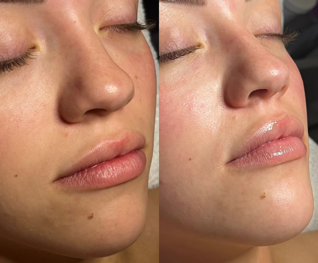 Hydrafacial Before and After Photo by The Skin Care Center in Pensacola, FL