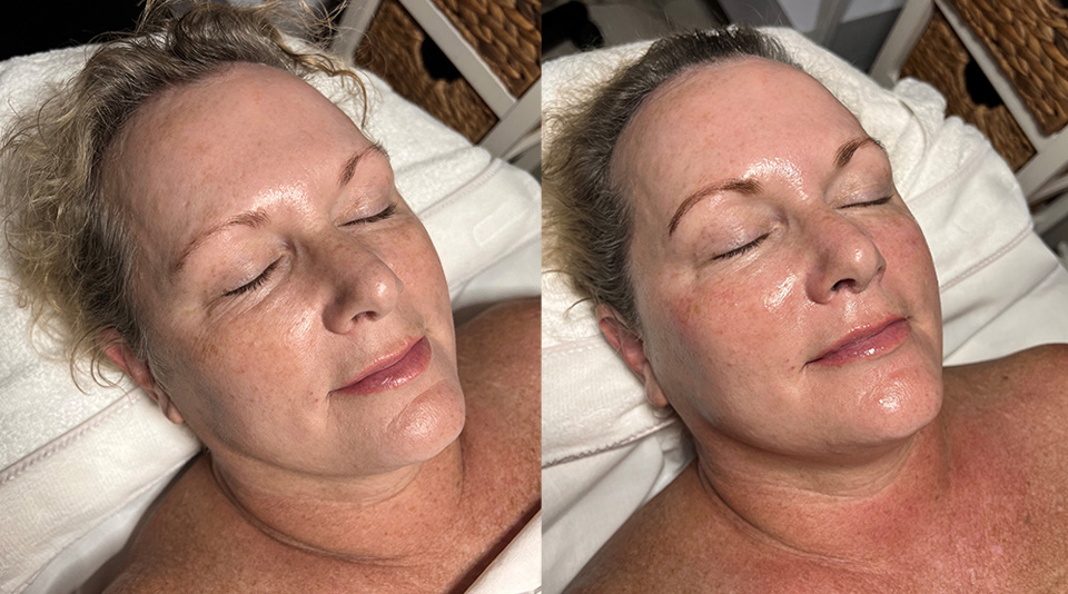 Hydrafacial Before and After Results