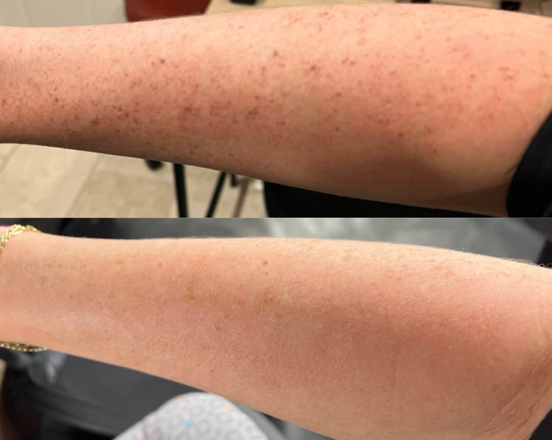 IPL Laser Treatment Before and After Photo by The Skin Care Center in Pensacola, FL