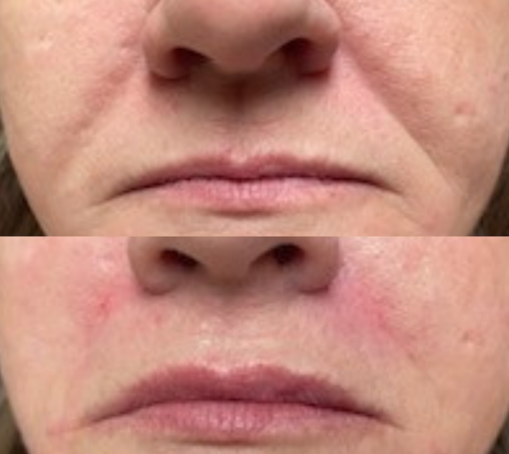 Lip Fillers Before and After by The Skin Care Center at Gulf Coast Plastic Surgery in Pensacola, FL