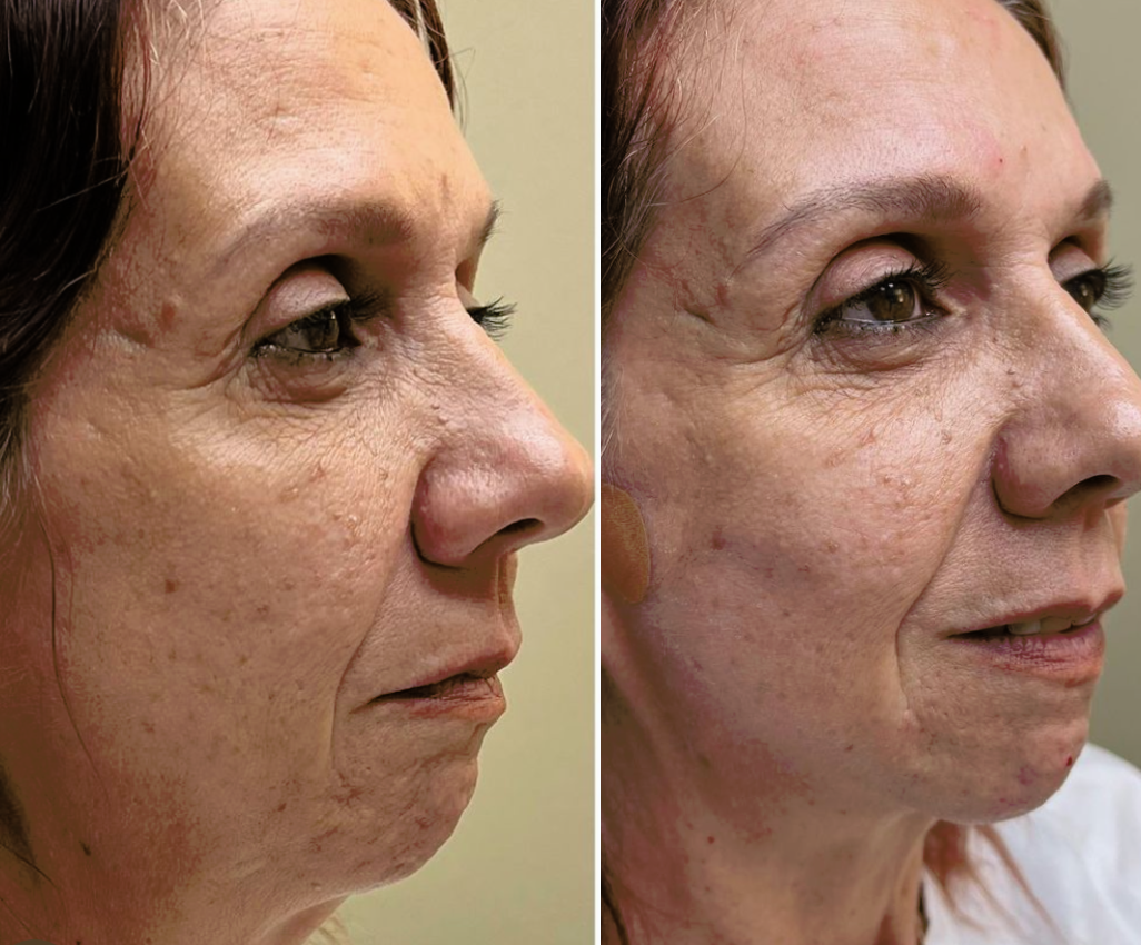 PDO Thread Lift Before and After Photo by The Skin Care Center in Pensacola, FL