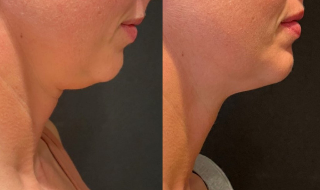 CoolSculpting Chin Before and After Photo by The Skin Care Center in Pensacola, FL