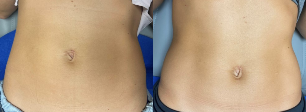 CoolTone of the abdomen Before and After Photo by The Skin Care Center in Pensacola, FL