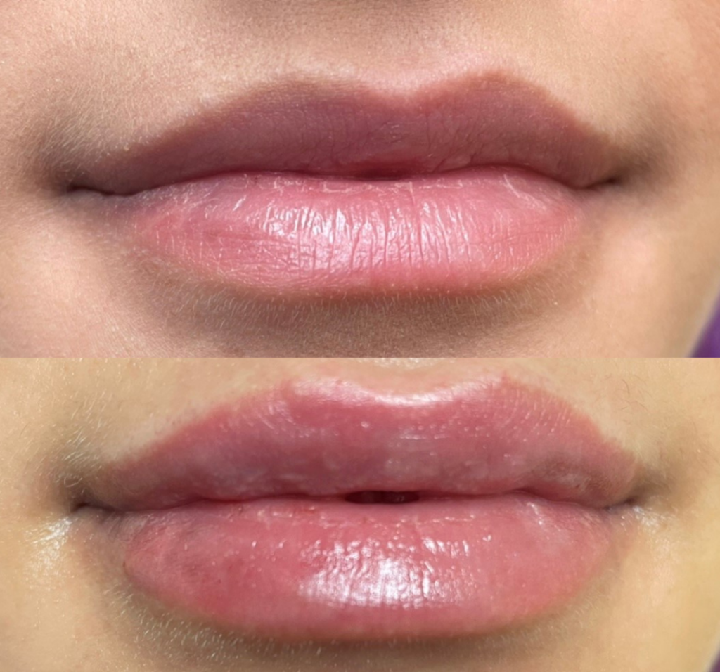 Dermal Filler Lips Before and After Photo by The Skin Care Center in Pensacola, FL