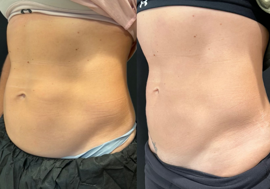 CoolSculpting Abdomen Before and After Photo by The Skin Care Center in Pensacola, FL