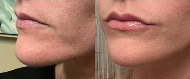 Botox Before and After Photo by The Skin Care Center in Pensacola, FL