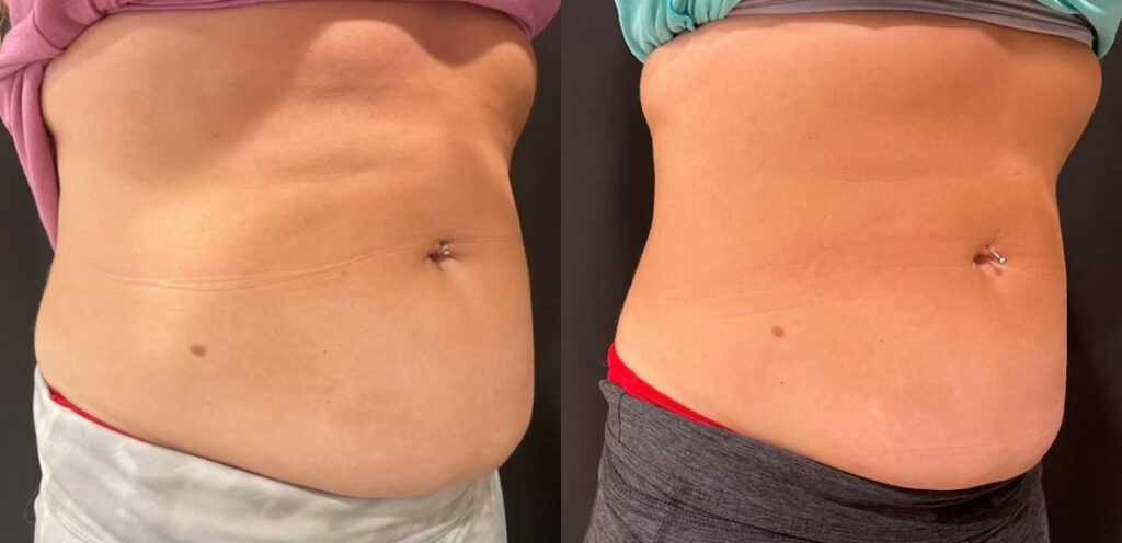 CoolSculpting Before and After Photo by The Skin Care Center in Pensacola, FL