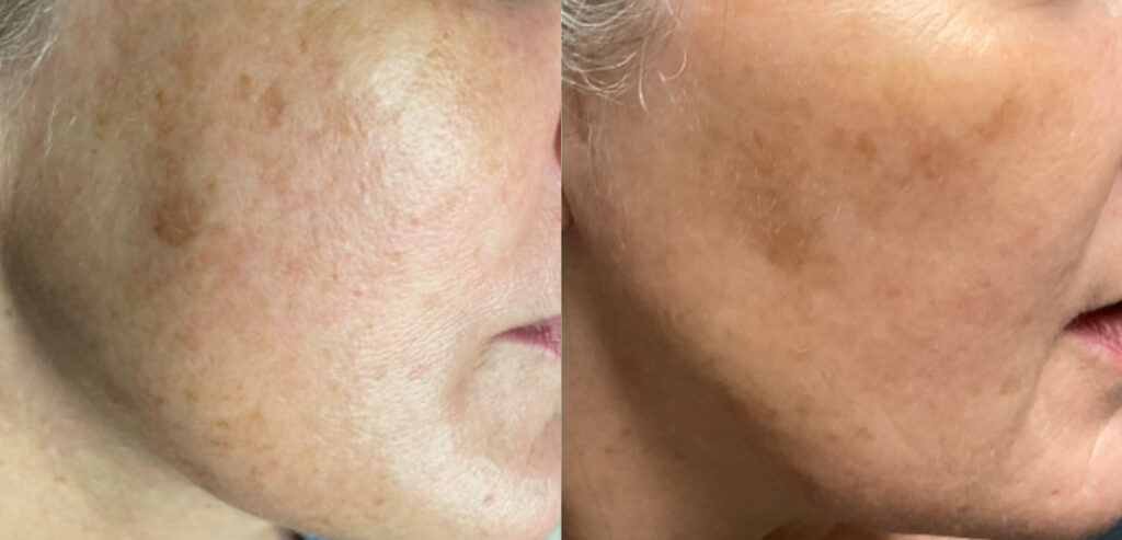 IPL Laser Treatment Before and After Photo by The Skin Care Center in Pensacola, FL