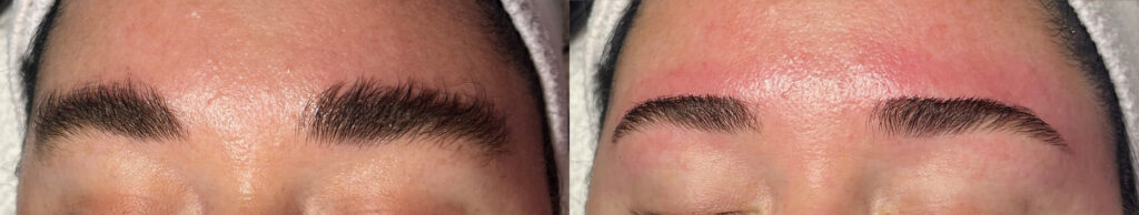 Eyebrows Before and After Photo by The Skin Care Center in Pensacola, FL