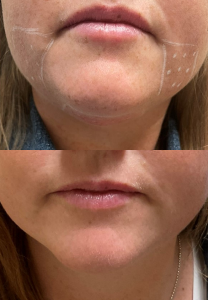 Kybella Before and After Photo by The Skin Care Center in Pensacola, FL