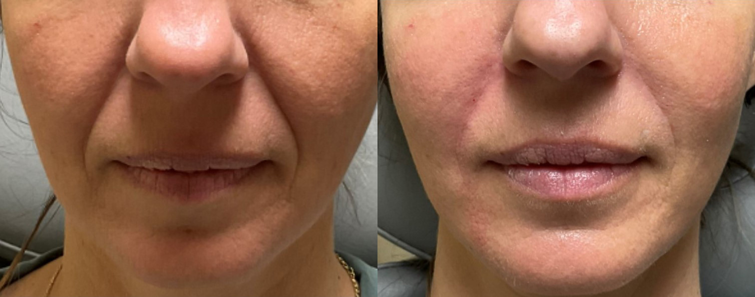 Nasolabial Folds Dermal Fillers Before and After Photo by The Skin Care Center in Pensacola, FL