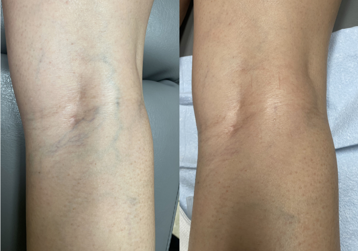 Sclerotherapy Before and After Photo by The Skin Care Center in Pensacola, FL