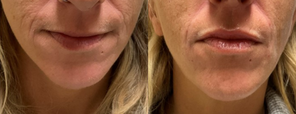 Upper Lip Fillers Before and After Photo by The Skin Care Center in Pensacola, FL