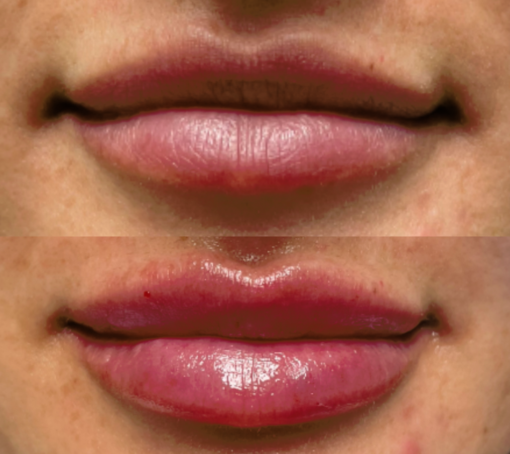 Lip Filler Before and After Photo by The Skin Care Center in Pensacola, FL