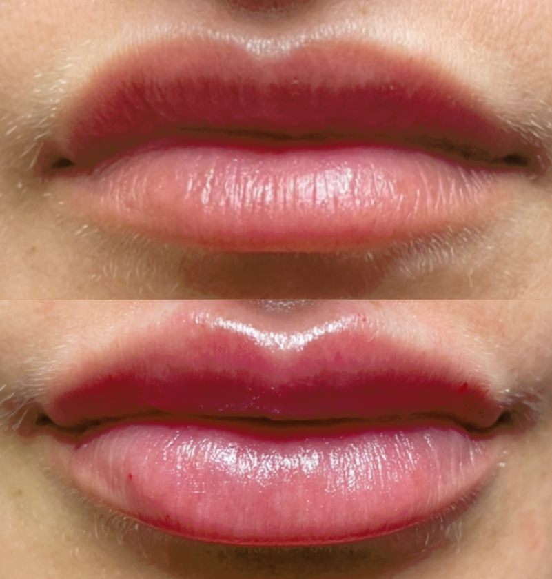 Lip Fillers Before and After Photo by The Skin Care Center in Pensacola, FL