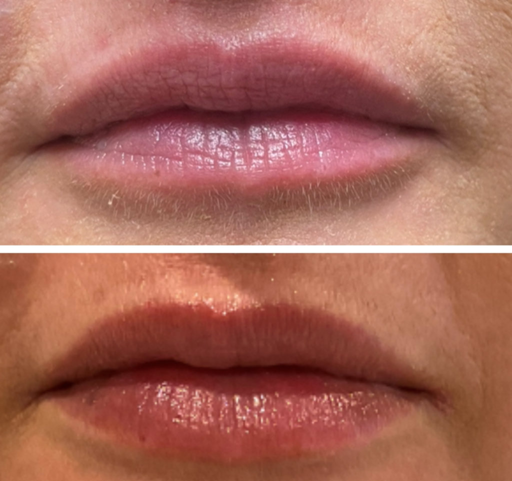 Lip Filler Before and After Photo by The Skin Care Center in Pensacola, FL