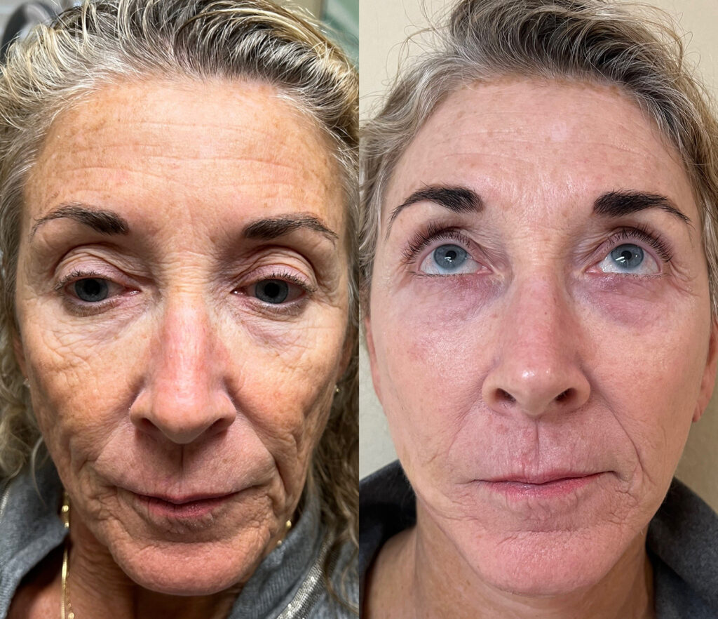 CO2 Laser Treatment Before and After Photo by The Skin Care Center in Pensacola, FL