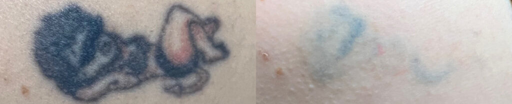 Tattoo Removal Before and After Photo by The Skin Care Center in Pensacola, FL