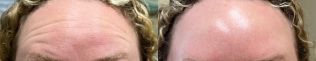 Botox to the forehead Before and After Photo by The Skin Care Center in Pensacola, FL