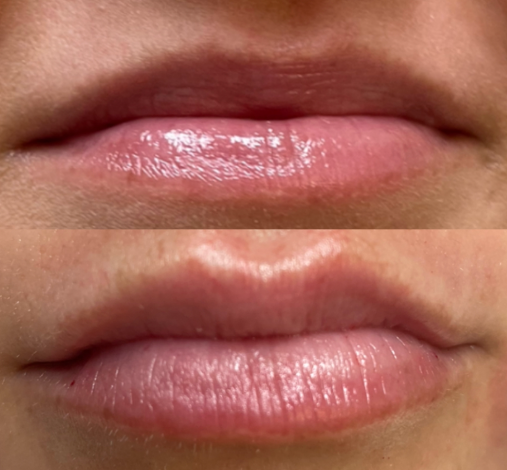 Lip Fillers Juvederm Before and After Photo by The Skin Care Center in Pensacola, FL