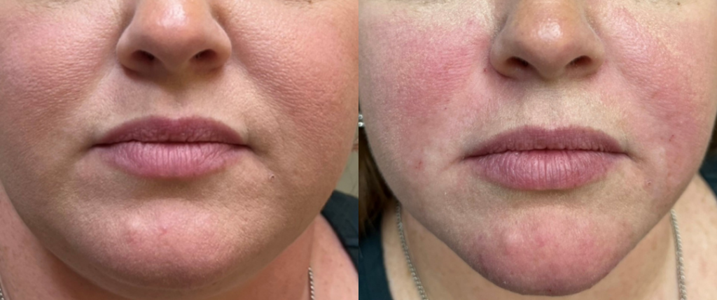 Voluma and Ultra Before and After Photo by The Skin Care Center in Pensacola, FL