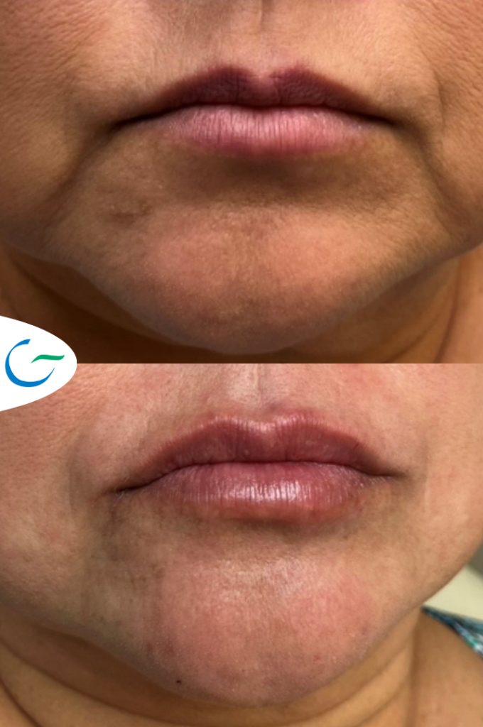 Lip Fillers Before and After Photo by The Skin Care Center in Pensacola, FL